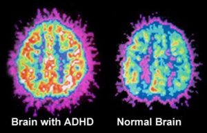 adhd-brain